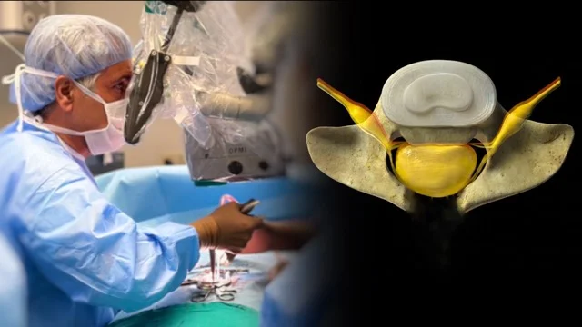 Boyun Kanal Daralması Ameliyatı (Posterior Servikal Laminektomi ve Lateral Mass Sabitleme)