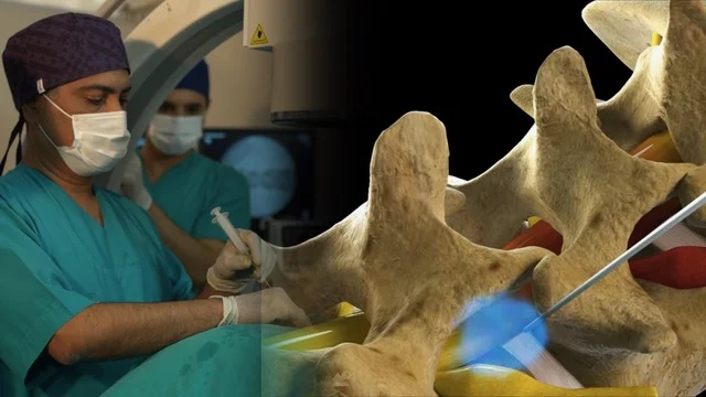 Bel Fıtığında Nokta Atışı Tedavisi (Transforaminal Epidural Enjeksiyon)
