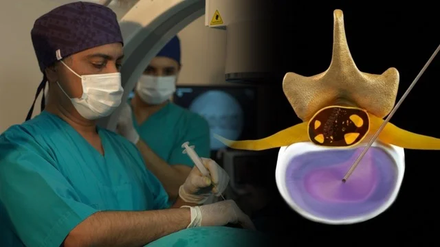 Bel Fıtığında Nükleoplasti Tedavisi