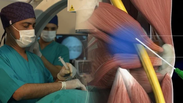 Siyatik: Nedenleri, Ayırıcı Tanısı ve Piriformis Kaynaklı Tedavi Yaklaşımı